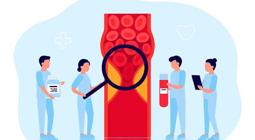 Как правильно питаться при атеросклерозе: секреты здорового рациона